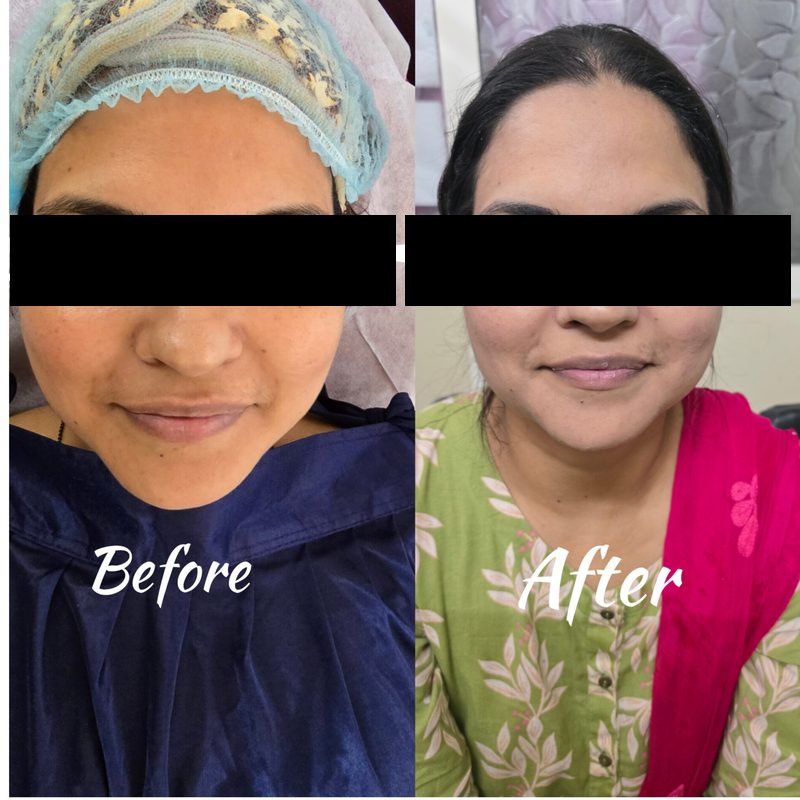 Facial Treatment - Before and After at Dhanvantri Clinic Khandwa