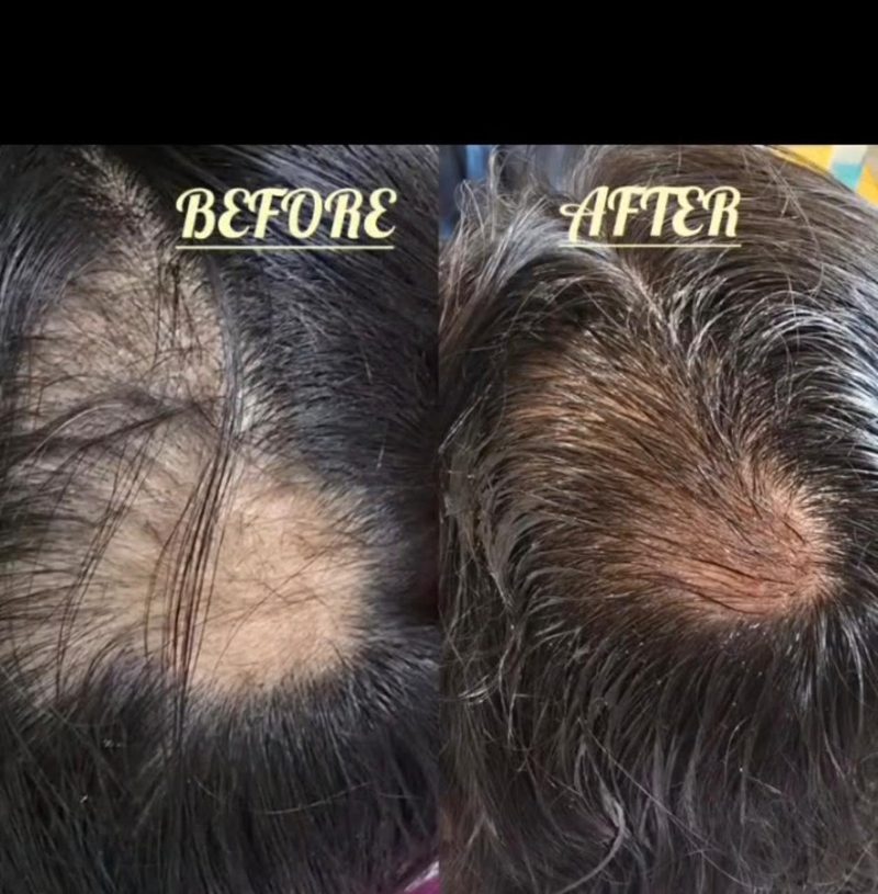 Hair Fall Treatment Before and After at Dhanvantri Clinic