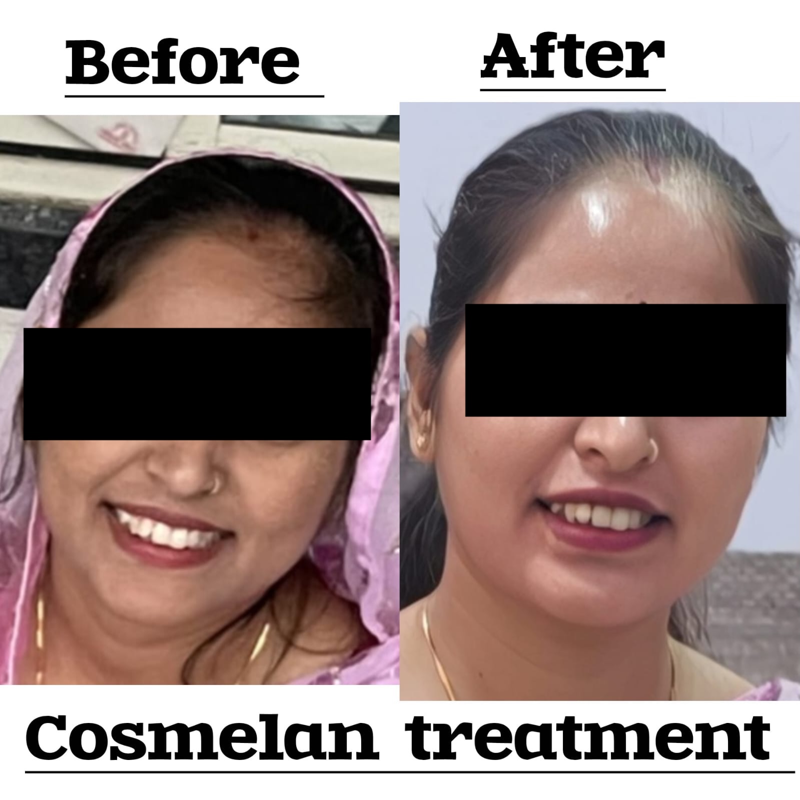 Melasma Treatment - Before and After results at Dhanvantri Clinic Khandwa