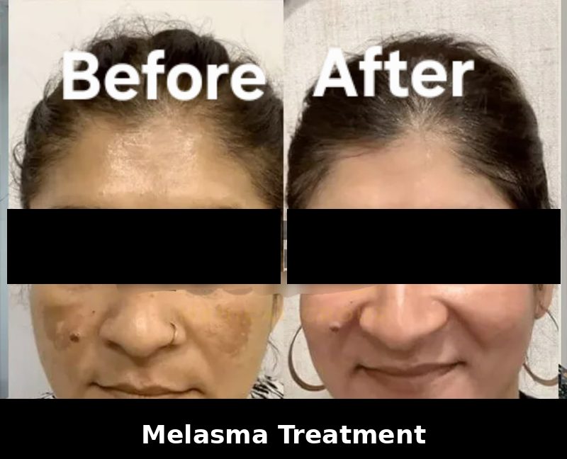 Melasma Peel Treatment - Before and After results at Dhanvantri Clinic Khandwa